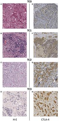 Biological Landscape of Triple Negative Breast Cancers Expressing CTLA-4